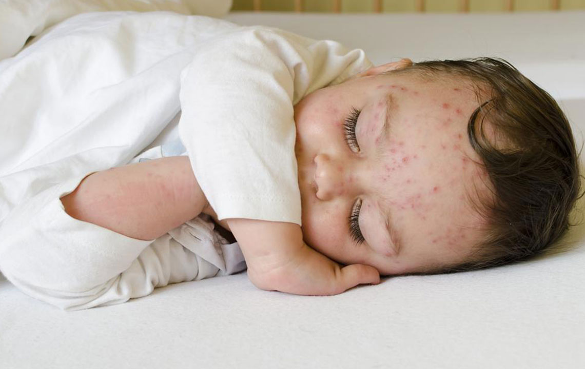 Here’s how to treat skin rashes in babies