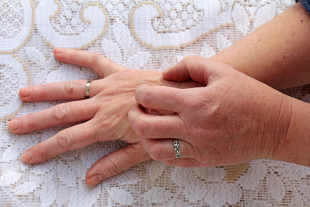 Scabies – Symptoms, Causes, and Treatment Options